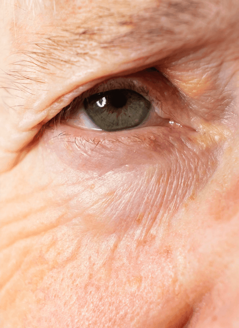 Image of Entropion-and-Ectropion-Repair.png